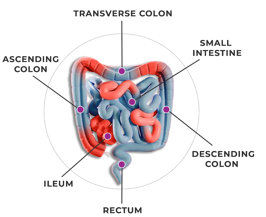 Areas of GI tract affected by Crohn's disease.