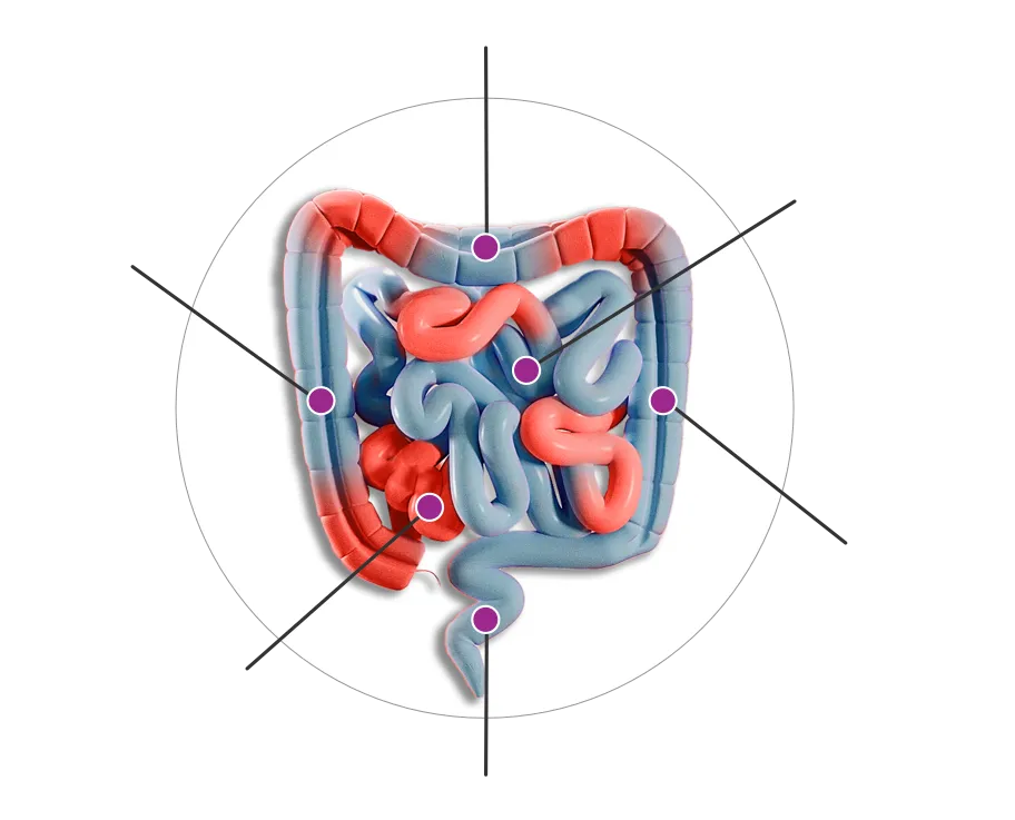 Areas of GI tract affected by Crohn's disease.