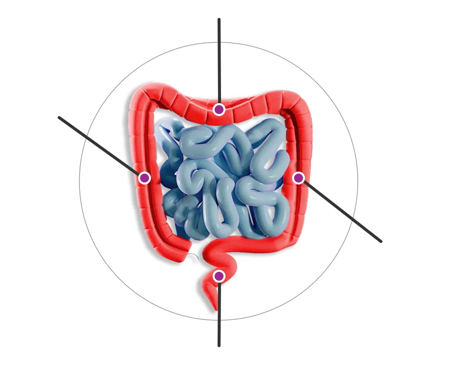 Areas of GI tract affected by ulcerative colitis.