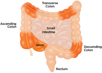 Areas of GI tract affected by Crohn's disease.